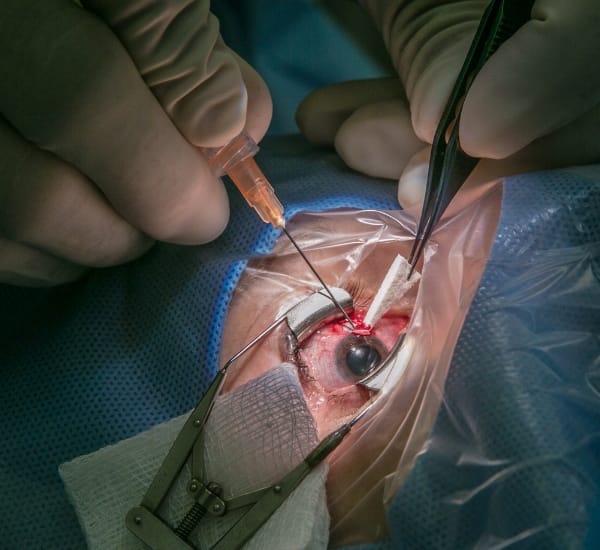 Cataract Surgery Cost Surat 5 Close-up view of cataract surgery procedure on patient's eye