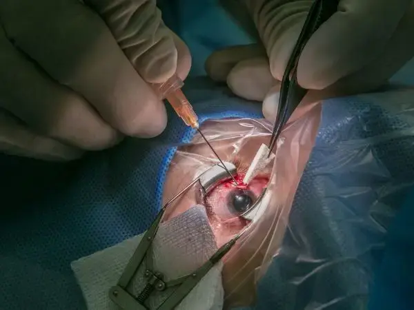 Glaucoma Surgery Surat 8 Glaucoma eye surgery procedure in Surat