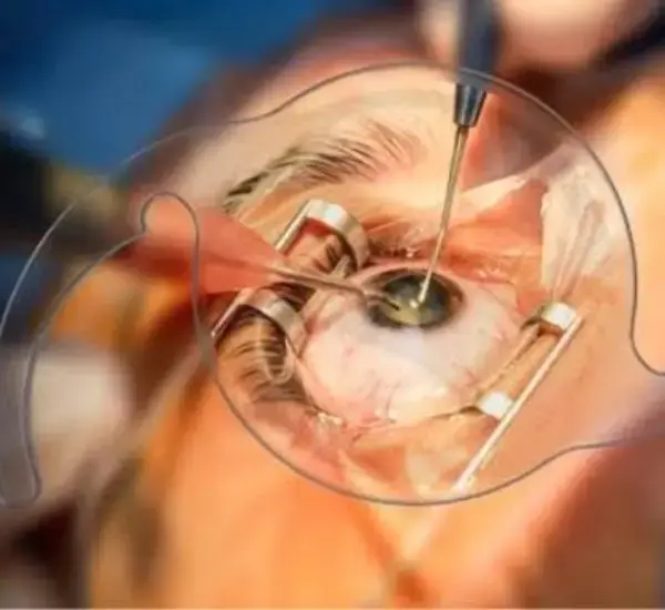 Cataract Symptoms And Treatment 1 Cataract Symptoms 3