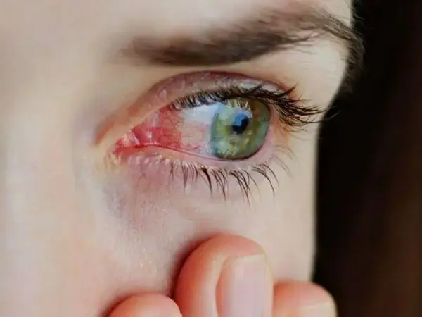 Early Signs of Glaucoma 3