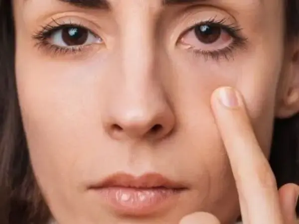 Early Signs of Glaucoma 4