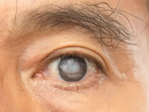 Glaucoma Symptoms and Treatment 2